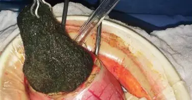 Une boule de 125g de cheveux retirés de l'estomac d'une petite fille de 5 ans