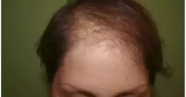 Attention, le shampooing sec cause la chute des cheveux !